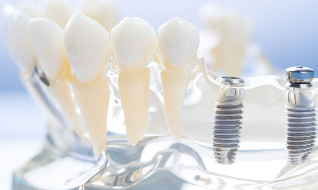 Implant and orthodontic model.