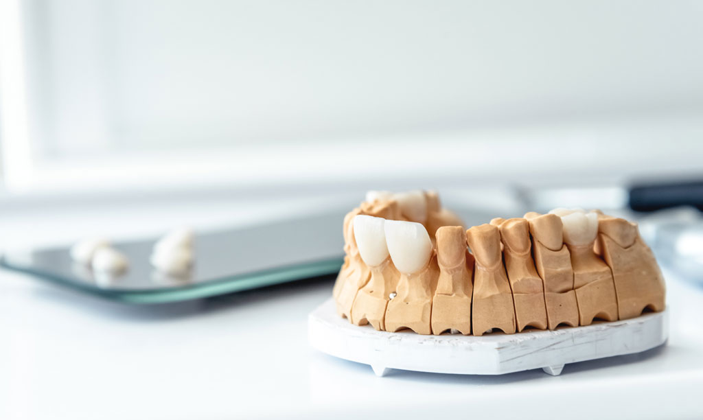 Dentures, veneers, crowns, implants are made in a dental laboratory